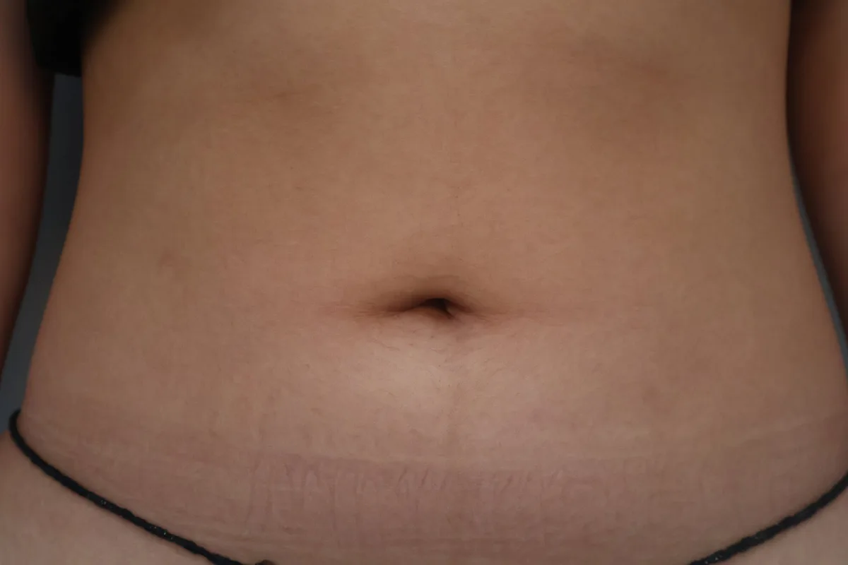belly-button-surgery-korea-real-before-after-results 相關圖片