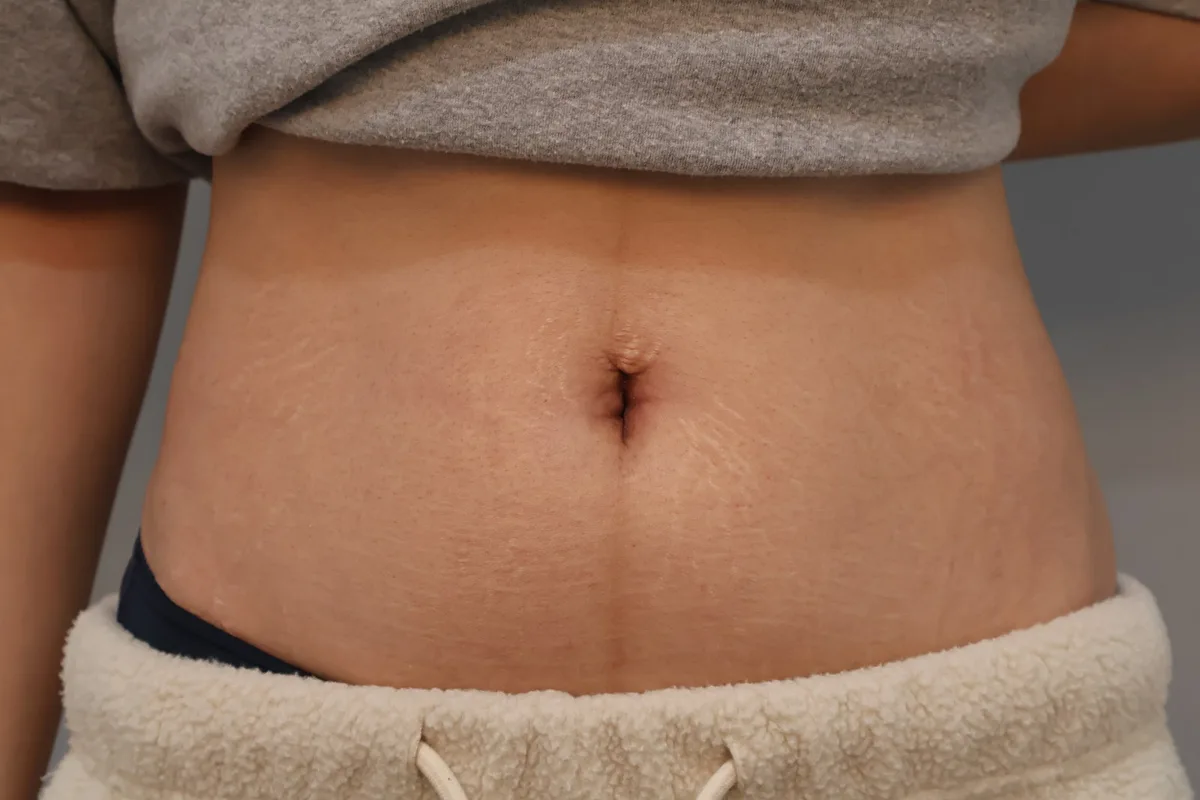 belly-button-surgery-korea-real-before-after-results 相關圖片
