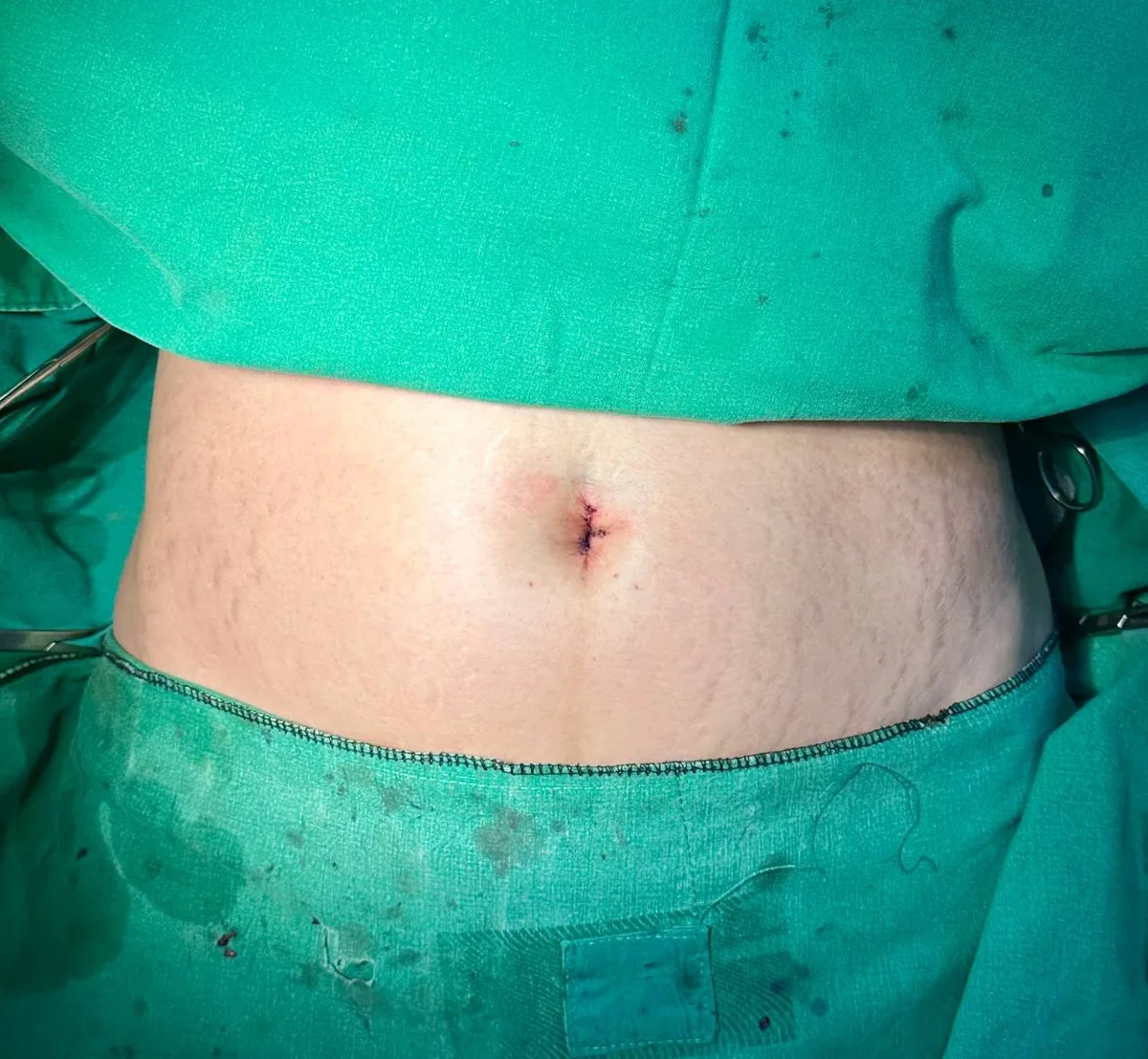 belly-button-surgery-korea-real-before-after-results 相關圖片