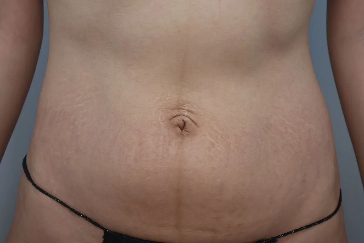 belly-button-surgery-korea-real-before-after-results 相關圖片