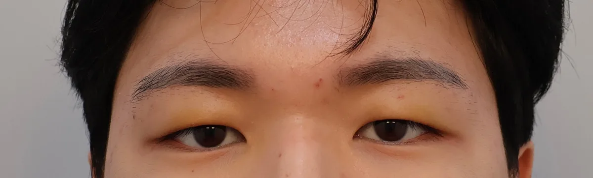 upper-eyelid-fat-removal-korea-real-results 相關圖片