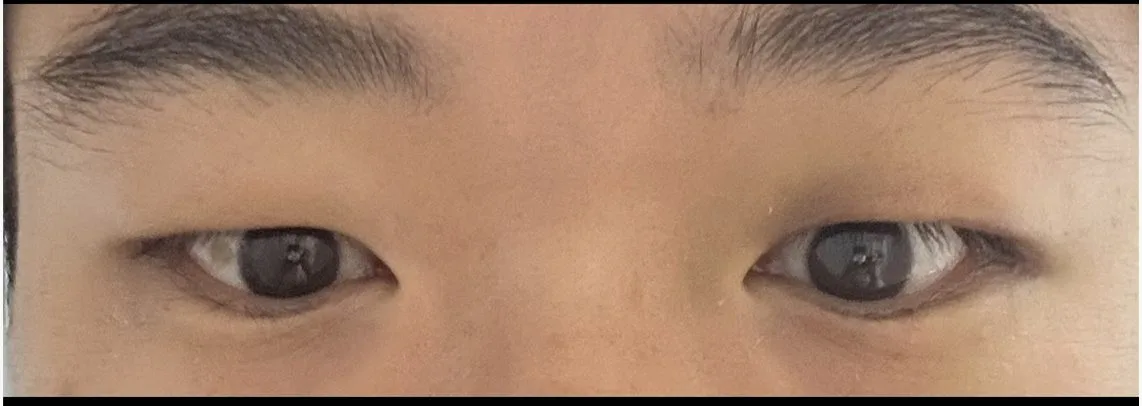 upper-eyelid-fat-removal-korea-real-results 相關圖片