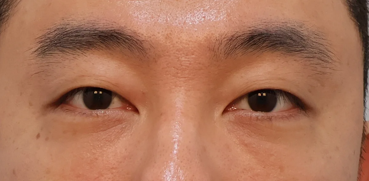 under-eye-fat-repositioning-korea-before-after-results 相關圖片