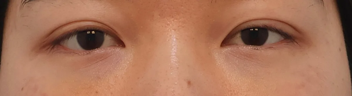 under-eye-fat-repositioning-korea-before-after-results 相關圖片