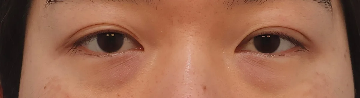 under-eye-fat-repositioning-korea-before-after-results 相關圖片
