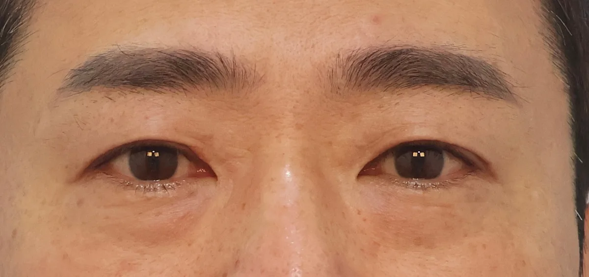 under-eye-fat-repositioning-korea-before-after-results 相關圖片