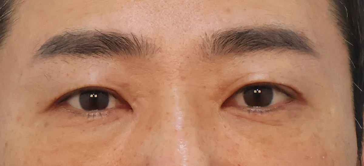 under-eye-fat-repositioning-korea-before-after-results 相關圖片