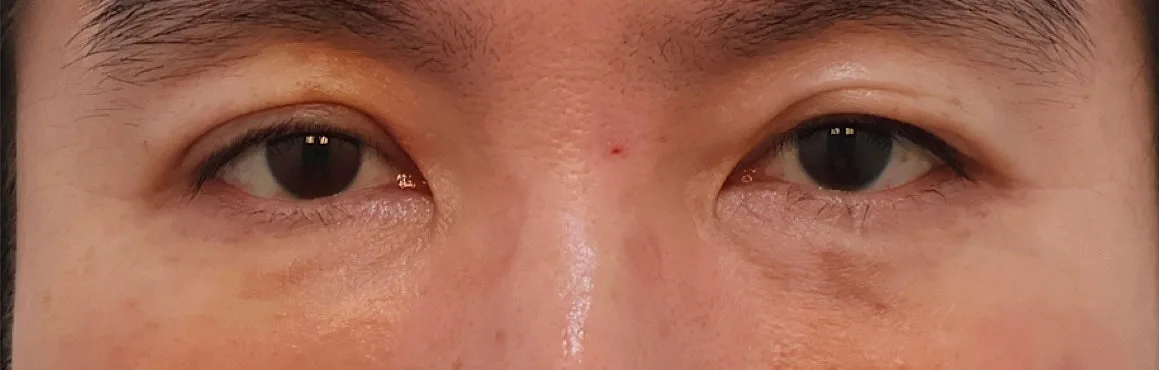 under-eye-fat-repositioning-korea-before-after-results 相關圖片