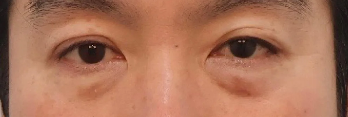 under-eye-fat-repositioning-korea-before-after-results 相關圖片