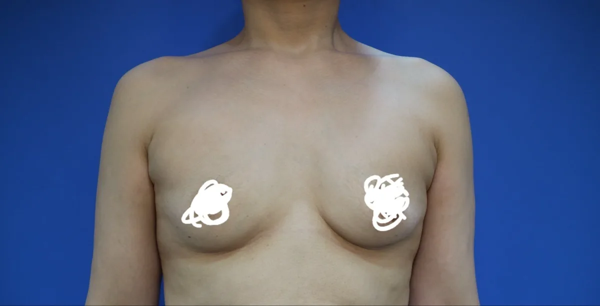 breast-augmentation-korea-recovery-photos-real-results 相關圖片