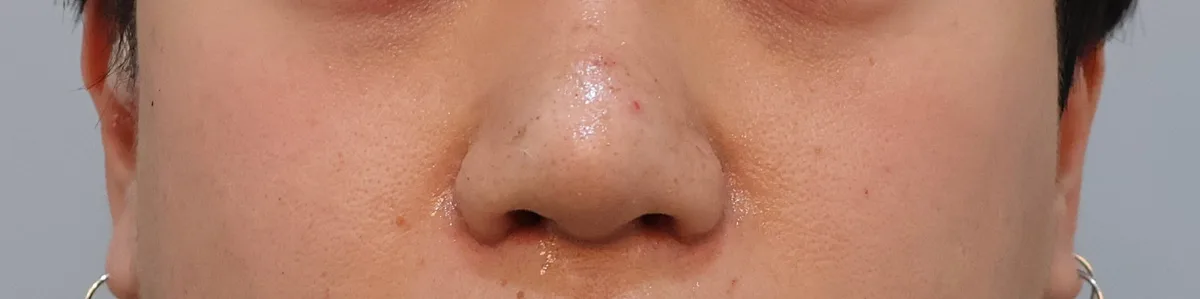 alar-reduction-korea-nostril-narrowing-real-results 相關圖片