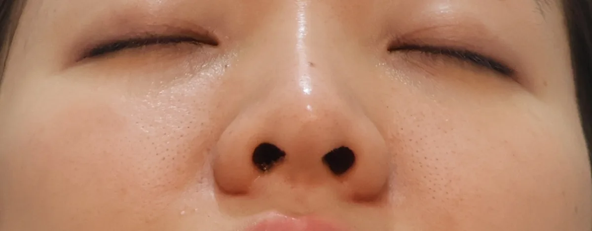 alar-reduction-korea-nostril-narrowing-real-results 相關圖片