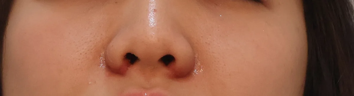 alar-reduction-korea-nostril-narrowing-real-results 相關圖片