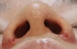 alar-reduction-korea-nostril-narrowing-real-results 相關圖片