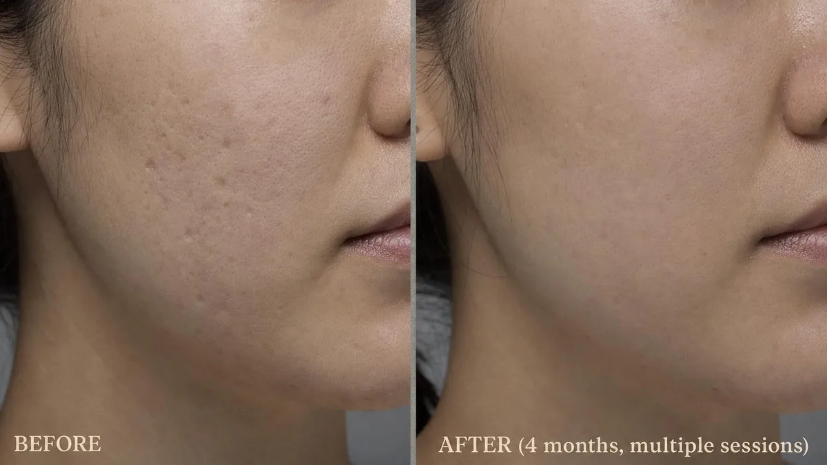 korean-acne-scar-treatment-options 相關圖片