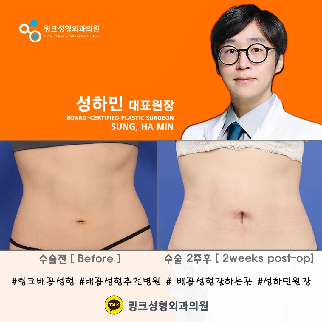 korean-belly-button-surgery-tummy-tuck 相關圖片