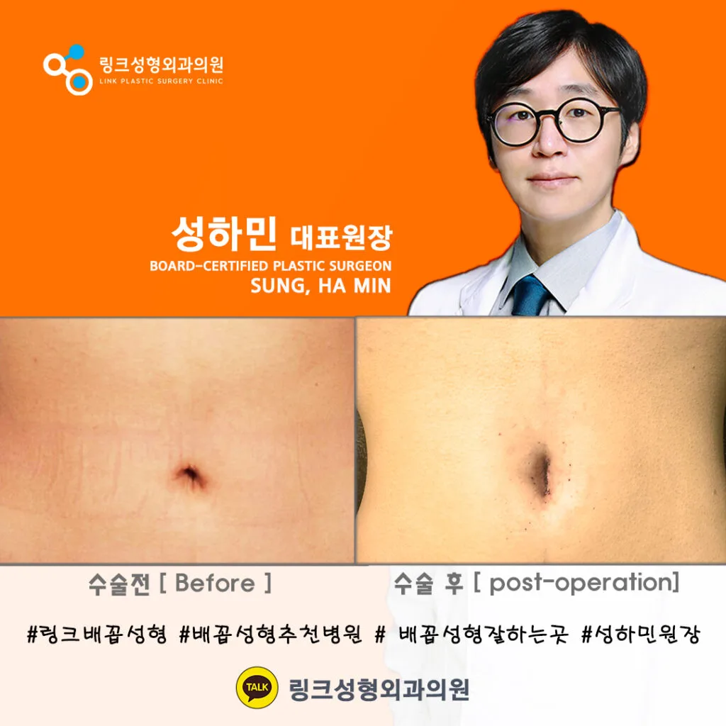 korean-belly-button-surgery-tummy-tuck 相關圖片