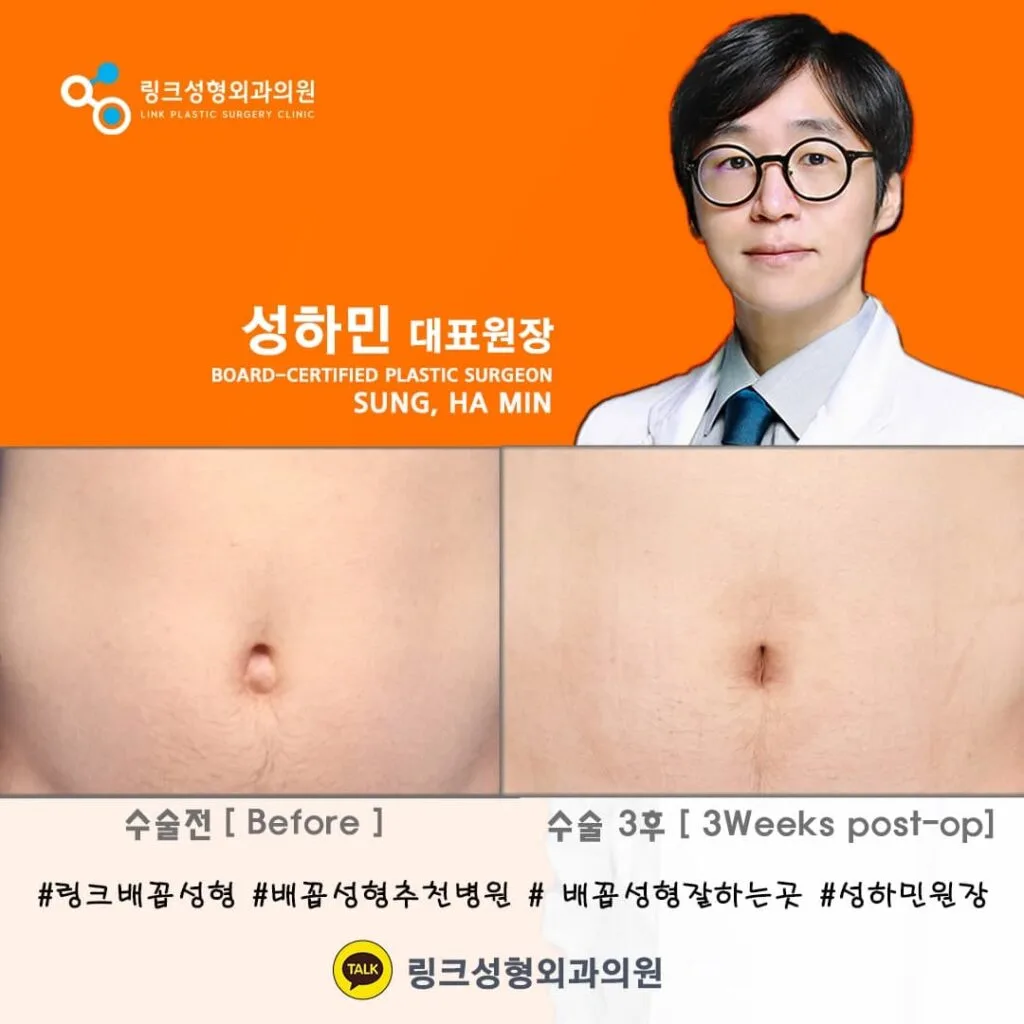 korean-belly-button-surgery-tummy-tuck 相關圖片