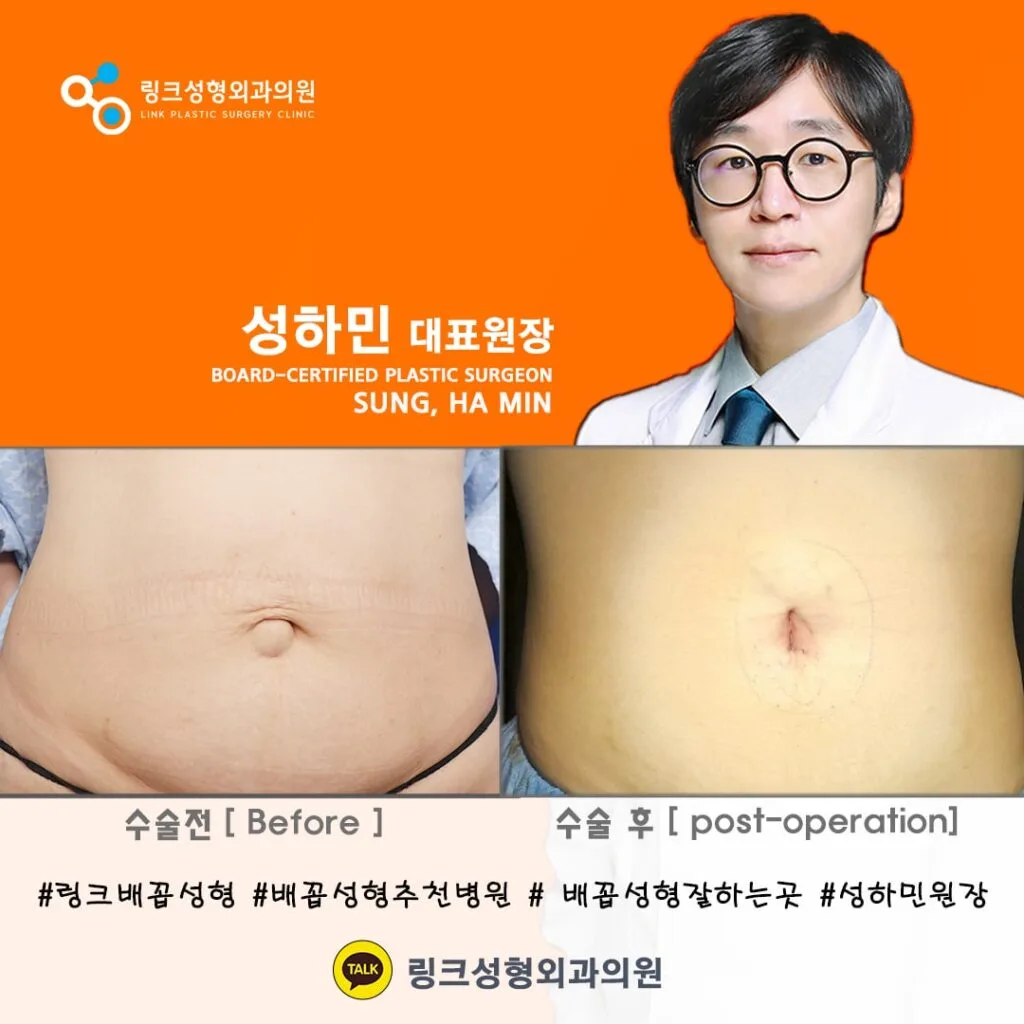 korean-belly-button-surgery-tummy-tuck 相關圖片