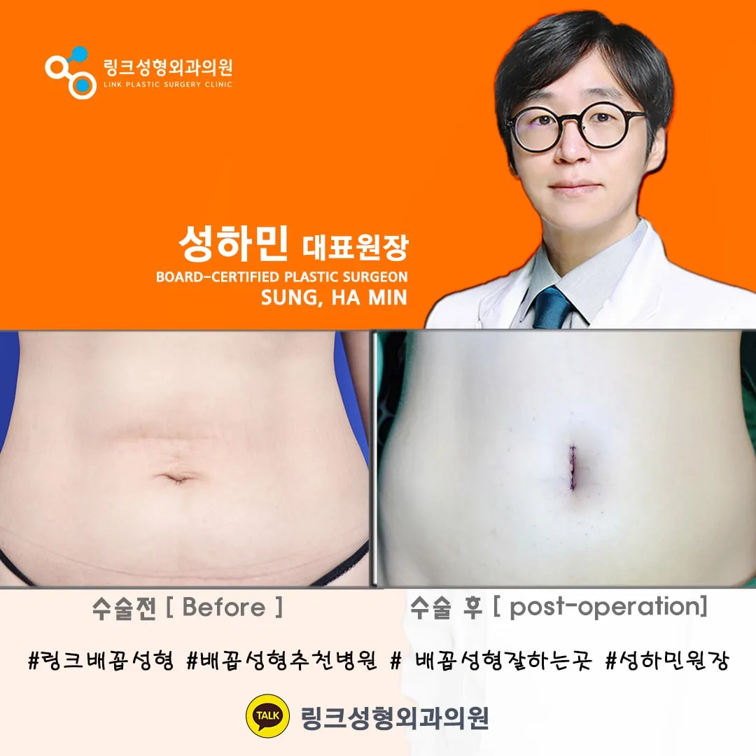 korean-belly-button-surgery-tummy-tuck 相關圖片