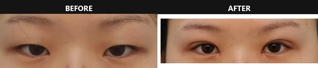 korean-double-eyelid-incision-vs-non-incision 相關圖片