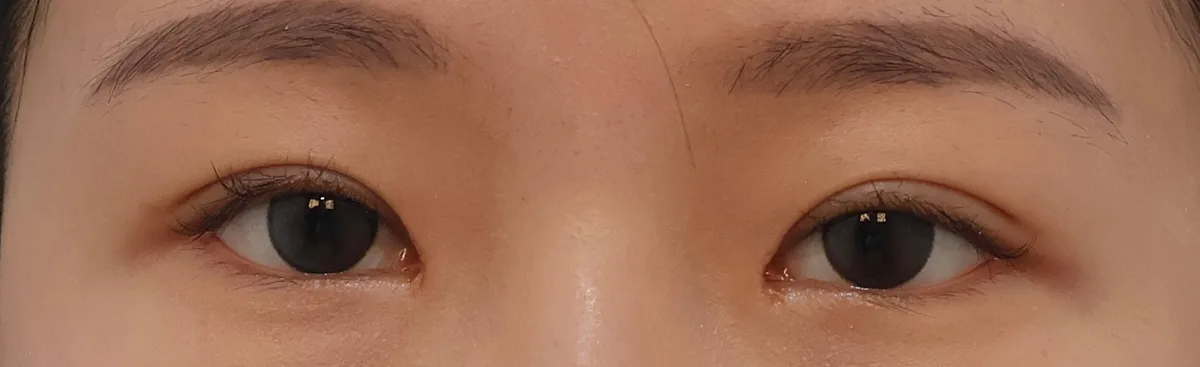 korean-double-eyelid-incision-vs-non-incision 相關圖片
