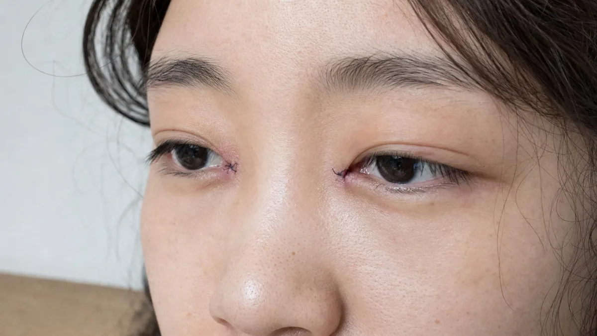 korean-epicanthoplasty-inner-corner-foreign-patients-guide 相關圖片