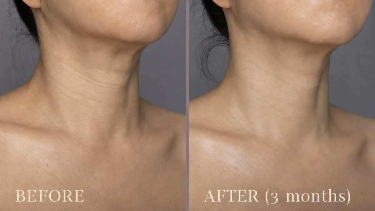 korean-neck-decolletage-aging-treatment 相關圖片