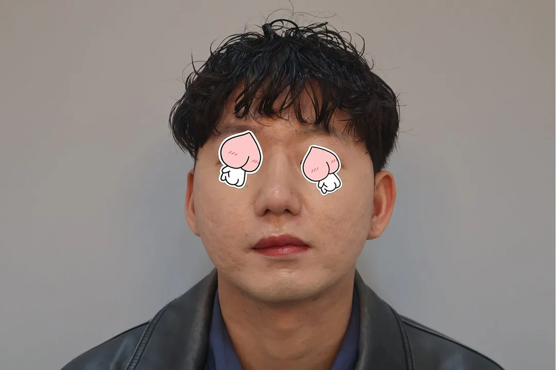 korean-rhinoplasty-1-month-recovery-foreign-patients-guide 相關圖片