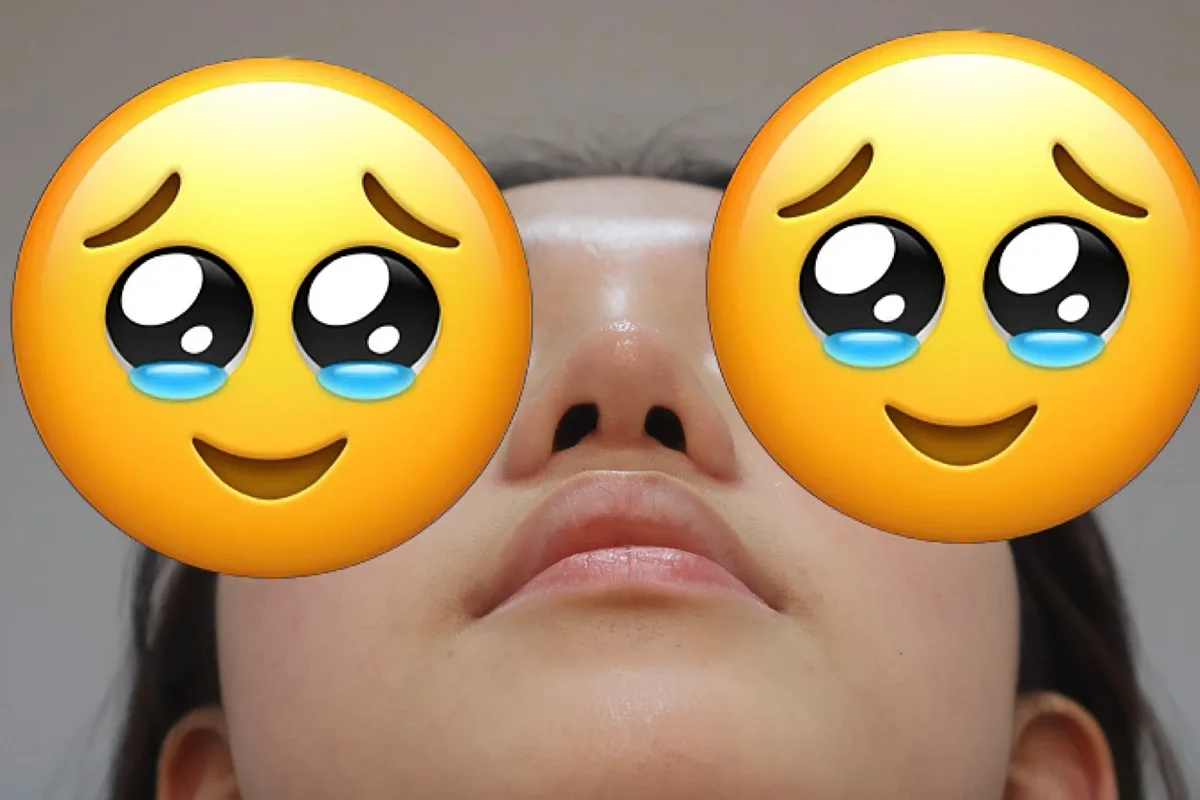 korean-rhinoplasty-results-1-month-recovery 相關圖片