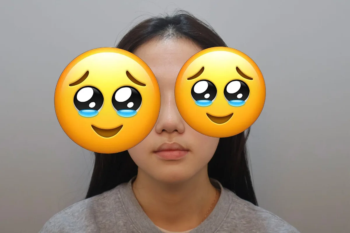 korean-rhinoplasty-results-1-month-recovery 相關圖片