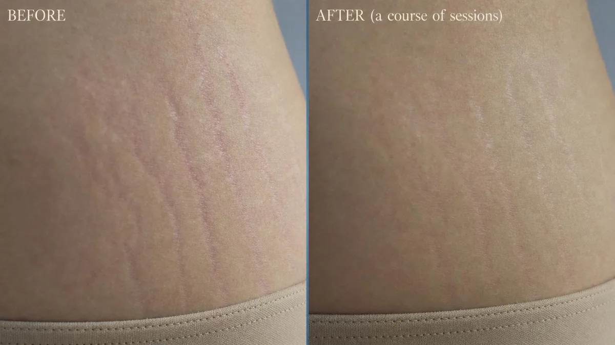 korean-stretch-mark-treatment 相關圖片