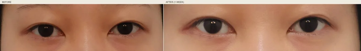 korean-upper-eyelid-fat-removal-foreign-patients-guide 相關圖片