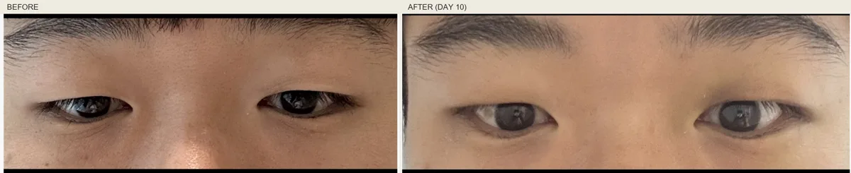 korean-upper-eyelid-fat-removal-foreign-patients-guide 相關圖片