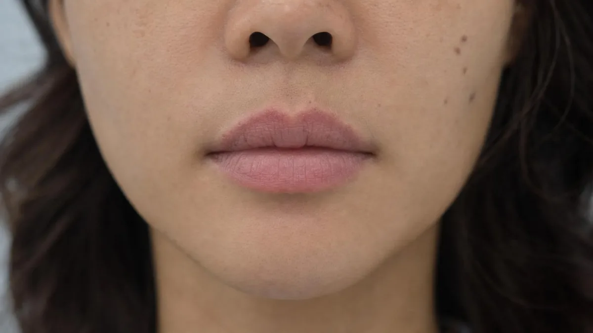 korean-lip-filler-restylane-kysse-foreign-patients-guide 相關圖片