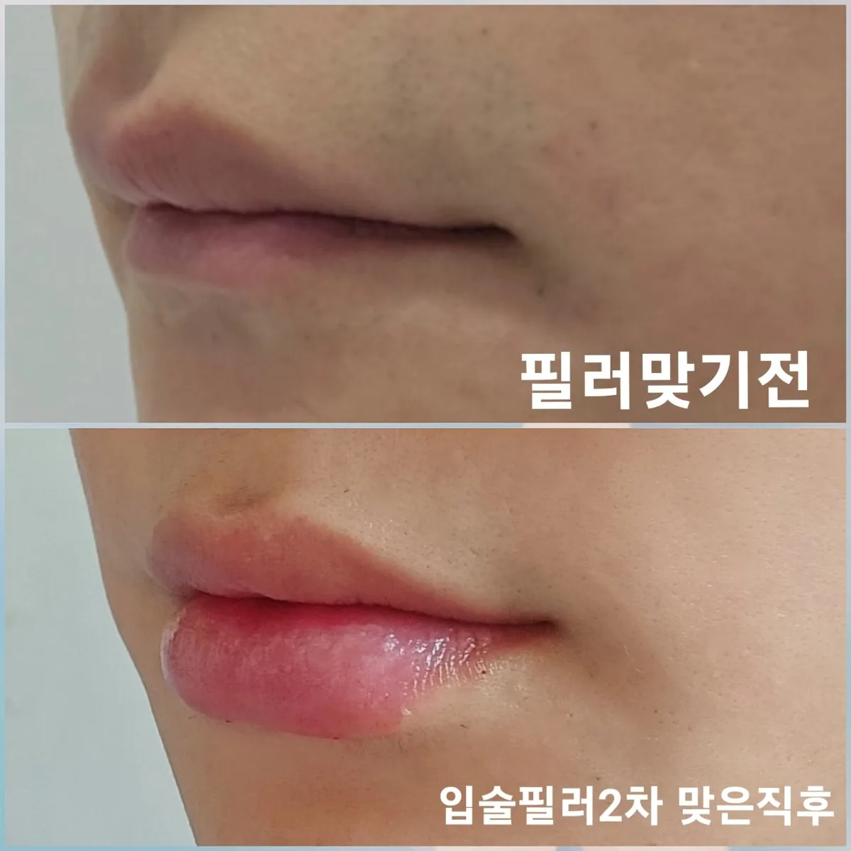 lip-filler-korea-real-results-korean-technique 相關圖片