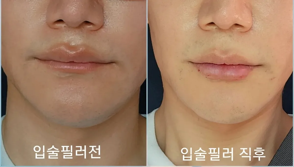lip-filler-korea-real-results-korean-technique 相關圖片