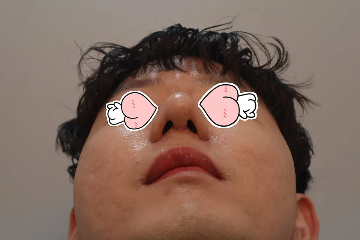 nose-tip-surgery-korea-tip-plasty-real-results 相關圖片
