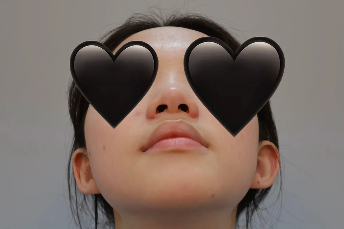 nose-tip-surgery-korea-tip-plasty-real-results 相關圖片