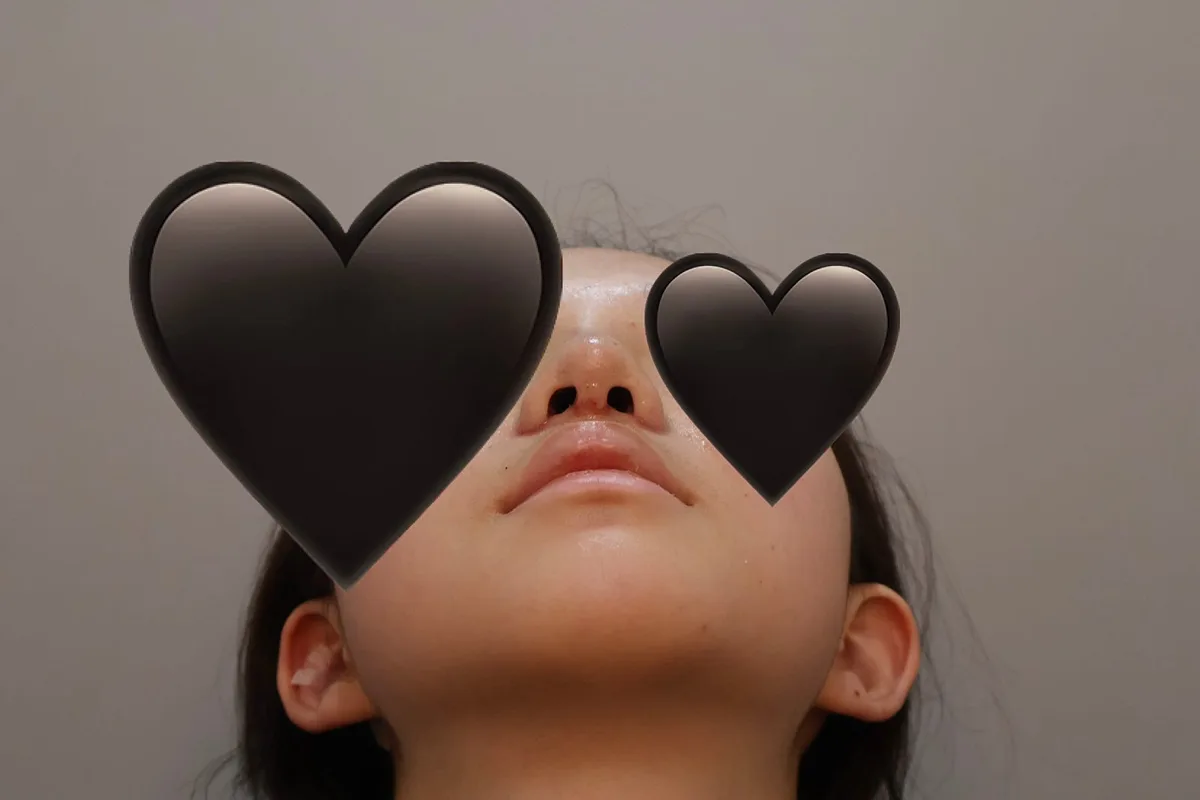 nose-tip-surgery-korea-tip-plasty-real-results 相關圖片