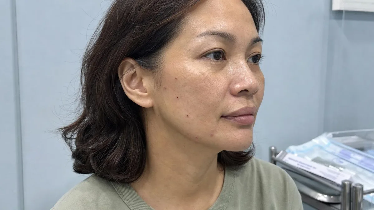 korean-flower-lift-thread-lift-foreign-patients-guide 相關圖片