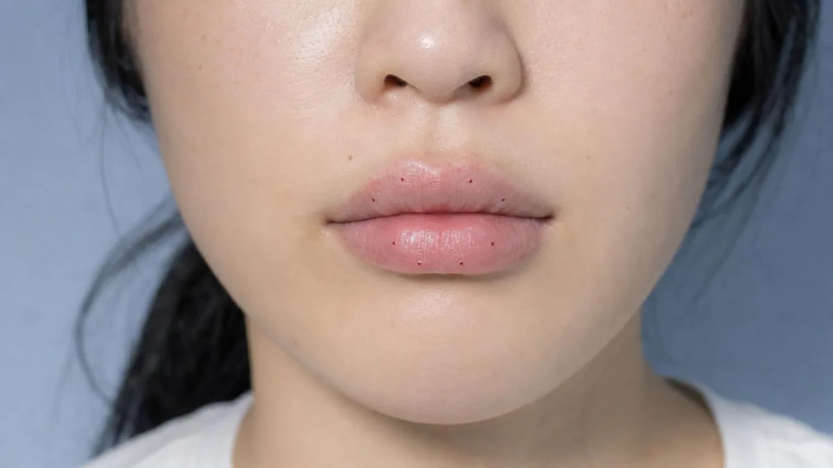 korean-lip-rejuran-pn-lip-regeneration-foreign-patients-guide 相關圖片