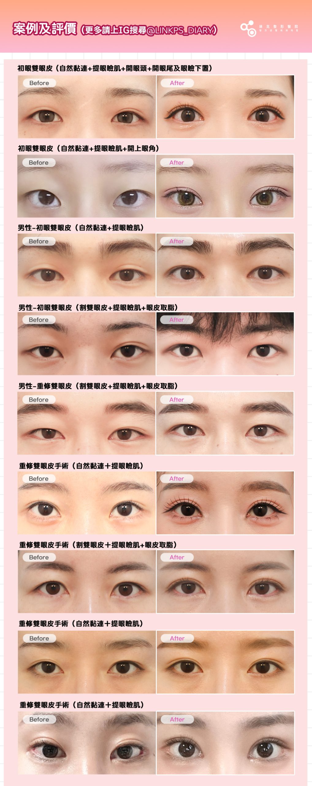 眼部整形 Before & After