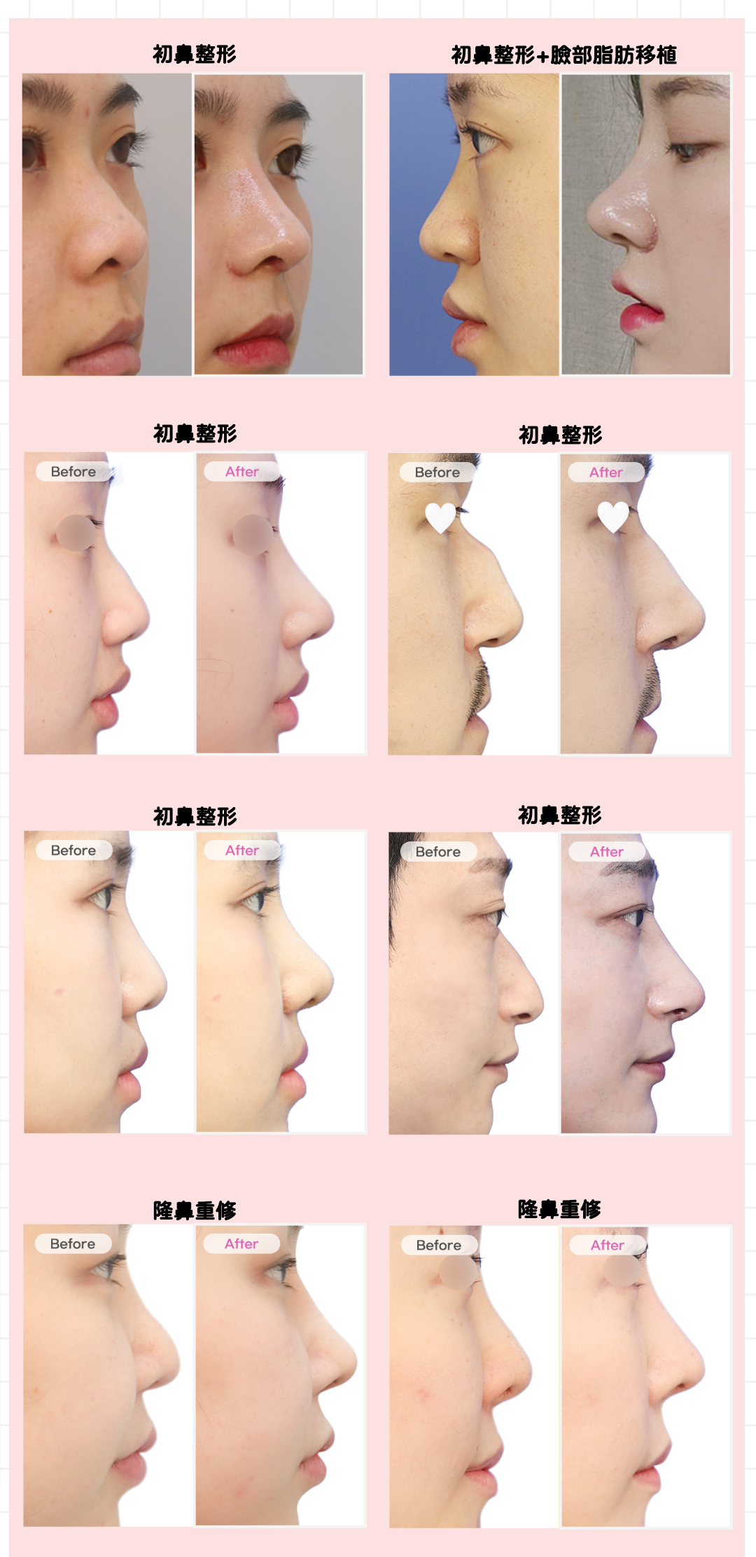 鼻部整形 Before & After