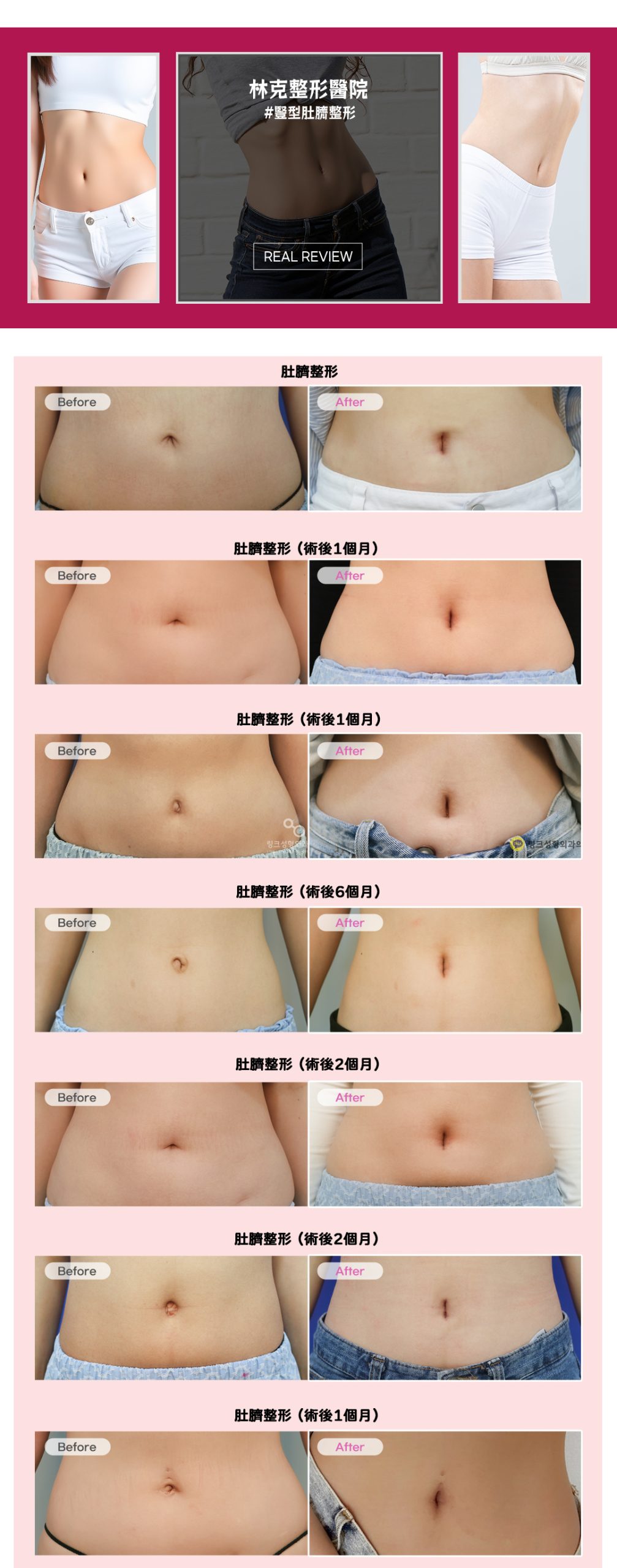 肚臍整形 Before & After